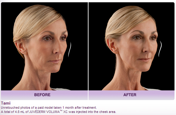 juvederm-voluma-before-and-after-photo