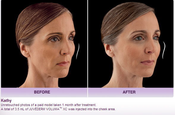 juvederm-voluma-before-and-after-picture
