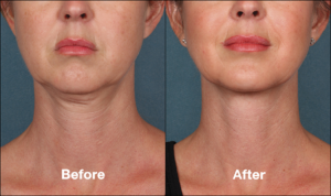 New Kybella Injections to Reduce Chin Fat in Northern Virginia