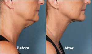 Kybella Chin Fat Reduction Injections Cost | Leesburg | Manassas