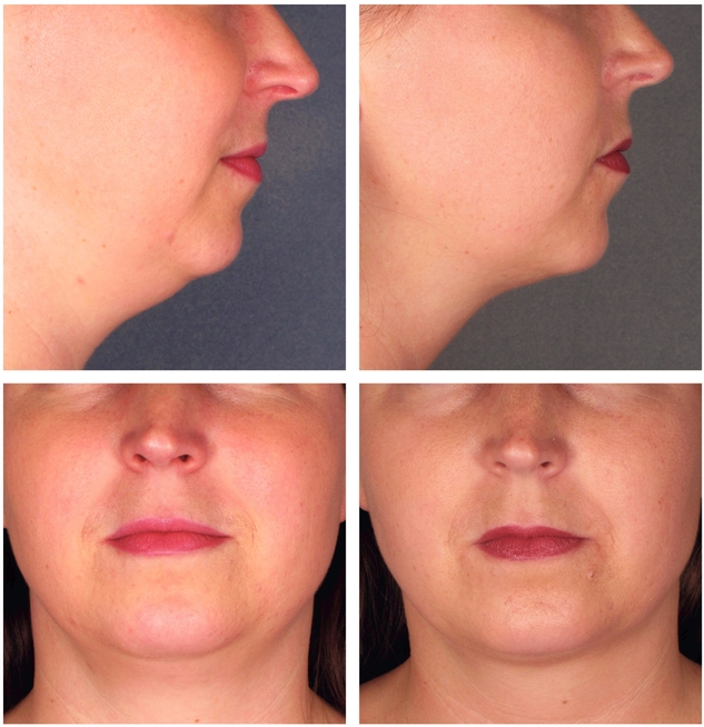 Chin Injections to Reduce Fat Beneath the Jawline