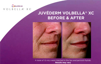 juvederm-volbella-before-and-after-pictures